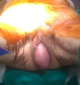 prolasso uterino