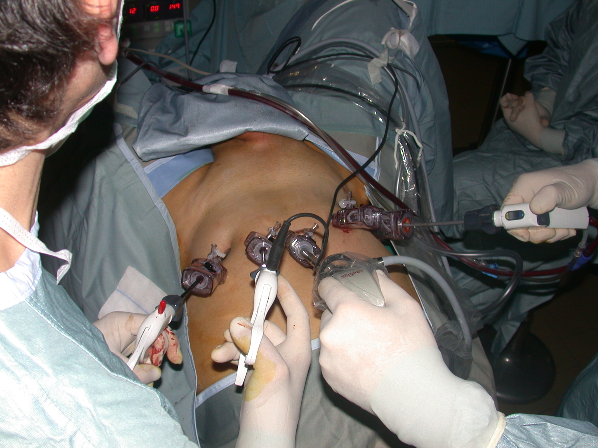 prostatectomia radicale laparoscopica complicanze)