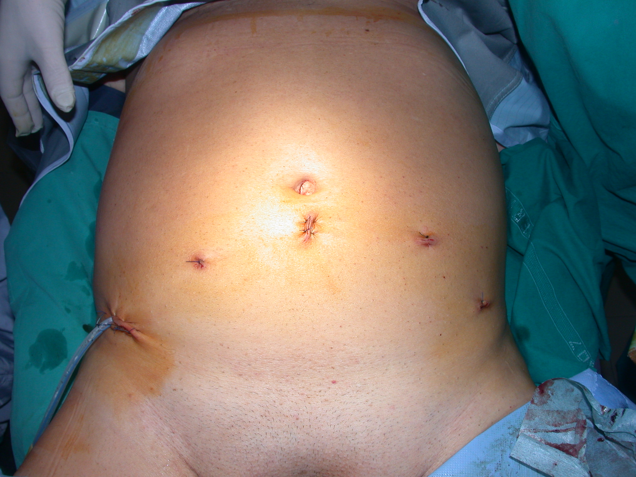 prostatectomia radicale laparoscopica)