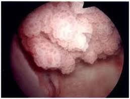 Papilloma virus e fibromi penduli - Papilloma peduncolato lingua