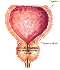 adenoma prostatico quando operare