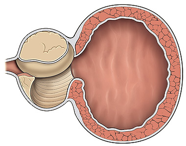 prostata ingrossata intervento endoscopico)
