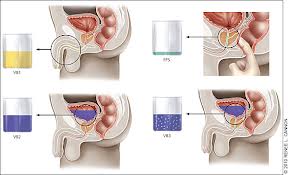 Exerciții pentru prostată și adenom de prostată pentru a preveni dezvoltarea procesului patologic