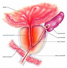 prostatite acuta)