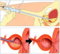 adenoma prostatico intervento)