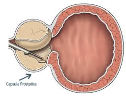 turp prostata recensioni pazienti